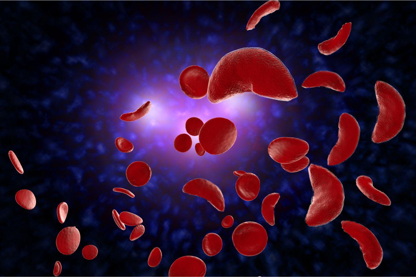 Sickle cells
